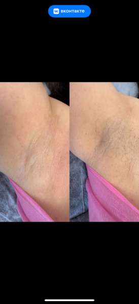 Шугаринг в Астрахани