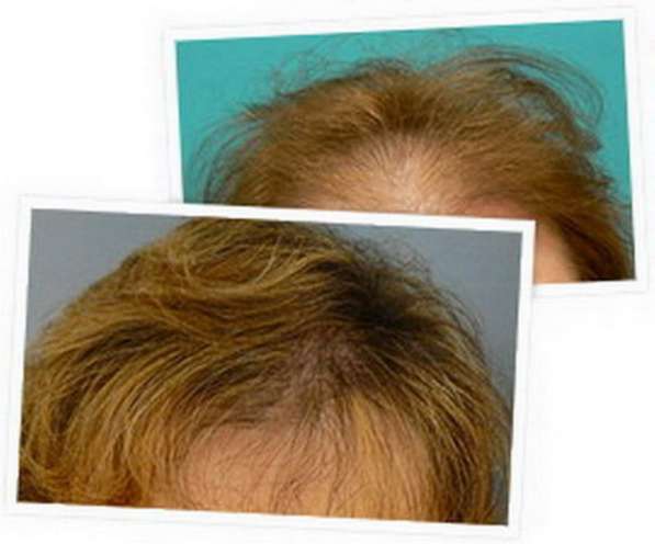 Спрей для восстановления и роста волос Ultra Hair Spray Syst в Москве фото 5